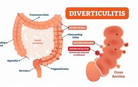 Image result for Diverticulitis Symptoms in Men