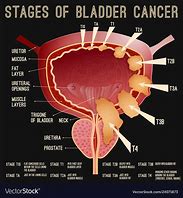 Image result for Malignant Bladder Tumor