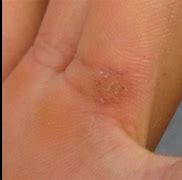 Image result for Seed Wart Removal