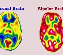 Image result for Bipolar Brain vs Normal