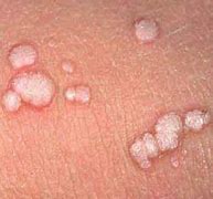 Image result for Female Genital Warts