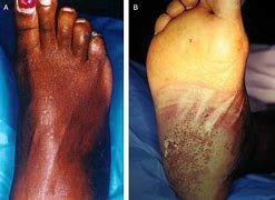 Image result for Syphilis Rash On Feet