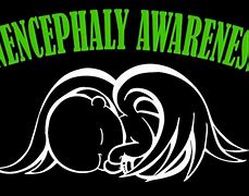 Image result for Anencephaly