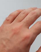 Image result for Clear Wart On Finger