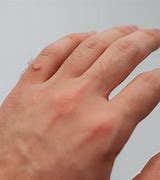 Image result for Wart Finger Pain