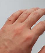 Image result for Warts On Hands