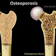 Image result for Osteoporosis Femur
