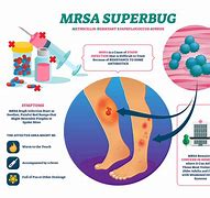 Image result for MRSA Disease