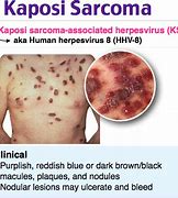 Image result for Kaposi Sarcoma Rash