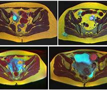 Image result for 7 Cm Cyst On Ovary