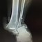 Image result for Bad Broken Ankle