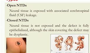 Image result for Neural Tube Defects Diagram