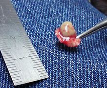 Image result for Plantar Warts On Feet Removal
