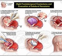 Image result for Craniectomy