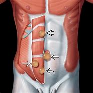 Image result for Small Intestine Hernia