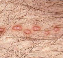 Image result for Molluscum Contagiosum Black