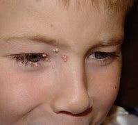 Image result for Molluscum Contagiosum Adults Face
