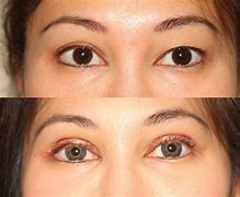 Image result for Day After Eyelid Surgery