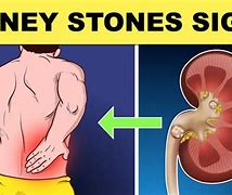 Image result for Kidney Stone Pain