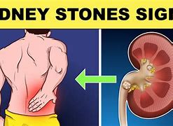 Image result for Kidney Stone Look Like