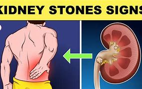 Image result for What Do Kidney Stones Look Like On Ultrasound