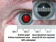 Image result for How Big Is 6Mm Pupil