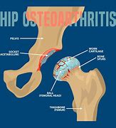 Image result for Wherre Can Bone Spur Grow Hip