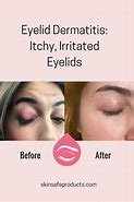 Image result for Eczema On Eyelids Treatment