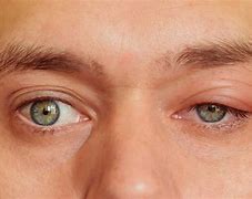 Image result for Symptom Swollen Eyelid