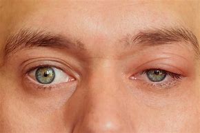Image result for Inflamed Eyelid