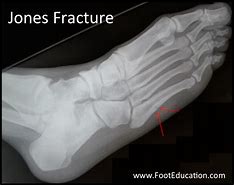 Image result for Jones Fracture Swelling
