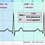 Image result for Heart Rate EKG Strip