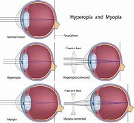 Image result for Myopia Concave Lens