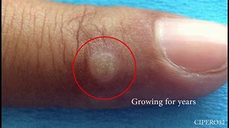 Image result for Wart Before and After Cryotherapy