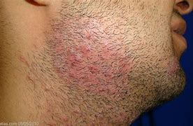 Image result for Tinea Barbae