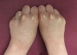 Image result for Hand with No Knuckles