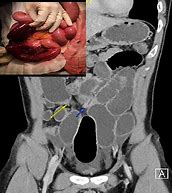 Image result for Dilated Small Bowel