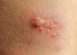 Image result for Bubble Blisters On Skin