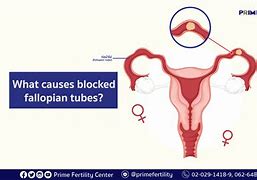 Image result for Blocked Fallopian Tube Symptoms