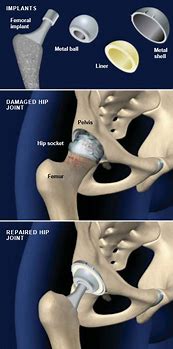Image result for What Does a Hip Replacement Look Like