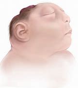 Image result for Exencephaly