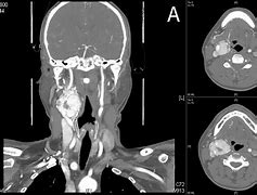 Image result for chemodectoma