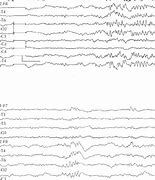Image result for Interictal EEG