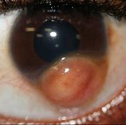Image result for Limbal Papillomas