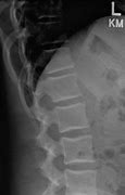 Image result for Pediatric Lumbar Spine