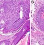 Image result for Adnexal Tumour Skin