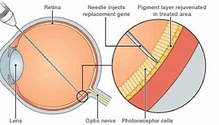 Image result for Eye Gene Therapy