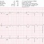 Image result for Ongoing ECG