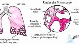 Image result for Interstitial Pneumonia Histology