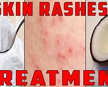 Image result for itch rash treatments